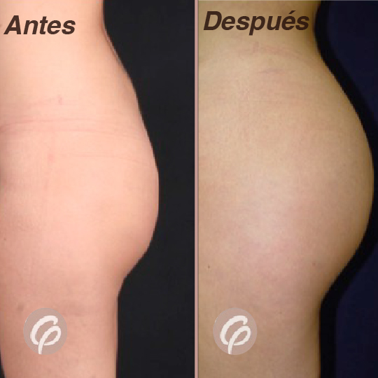 antes y despues-06