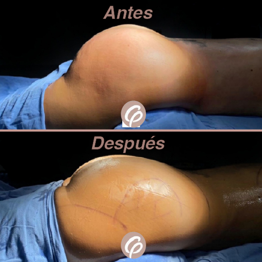 antes y despues-07
