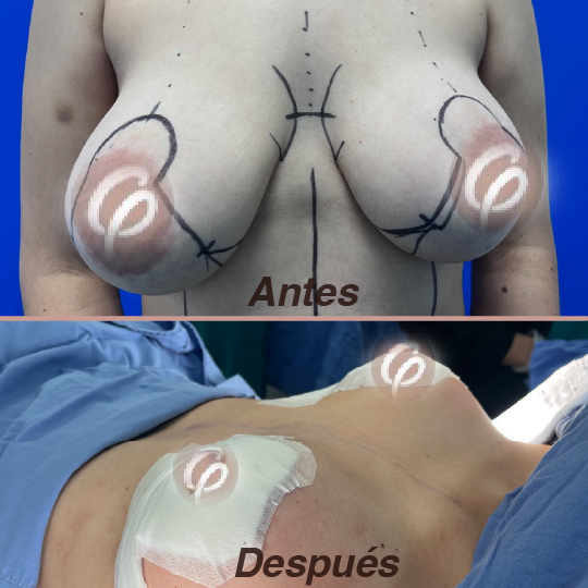 antes y despues-09