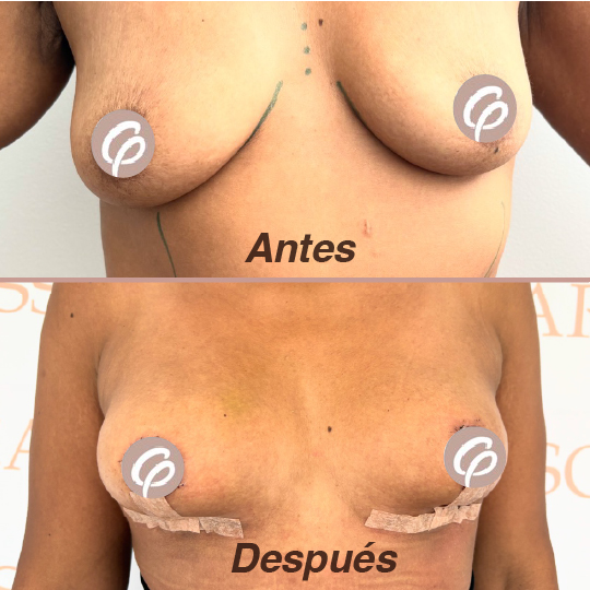 antes y despues-10