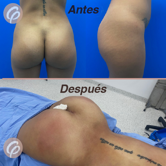 antes y despues-11
