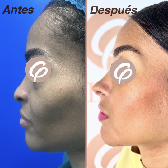 antes y despues-15
