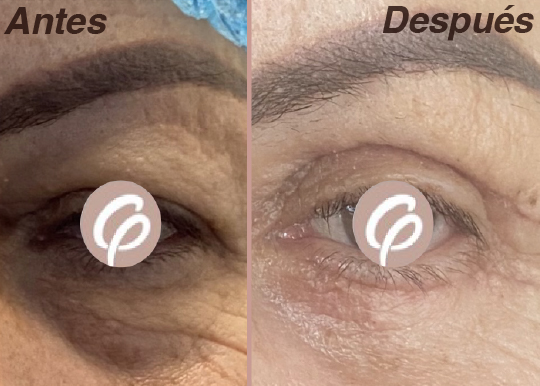 antes y despues-19