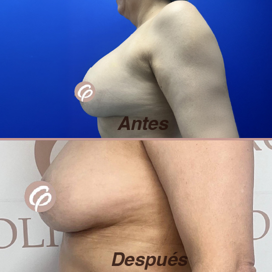 antes y despues-24
