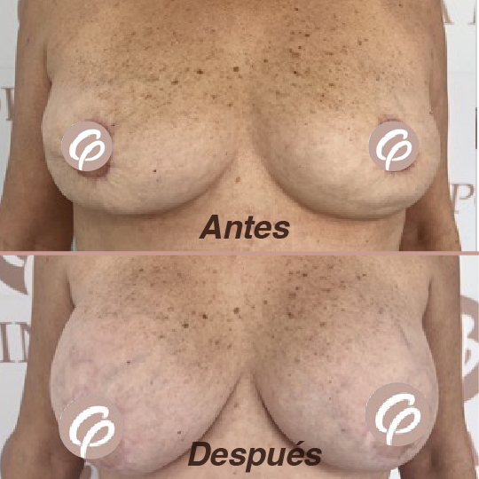 antes y despues-27