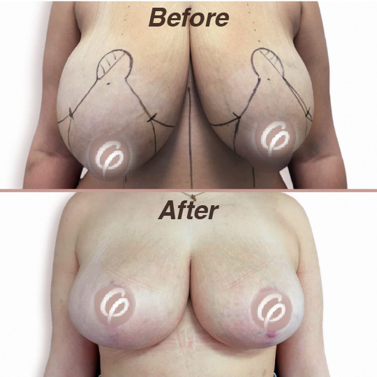 before and after-04