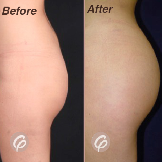 before and after-06
