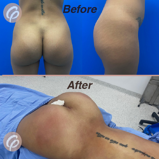 before and after-11
