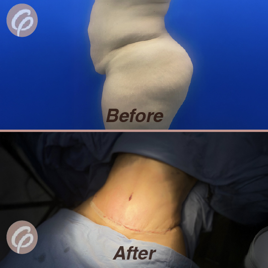 before and after-12