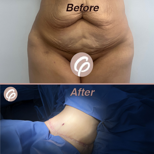 before and after-13