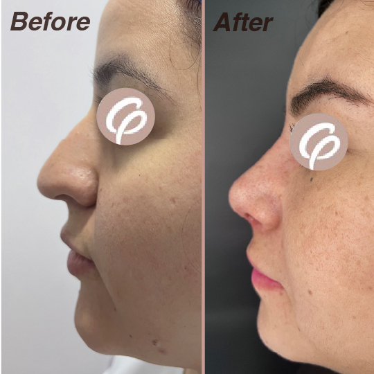 before and after-14