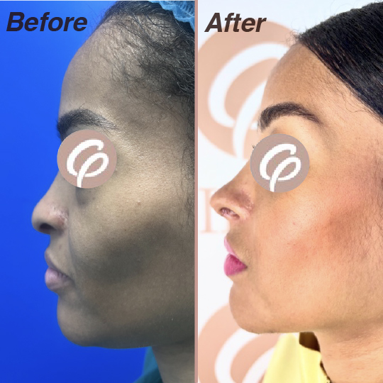 before and after-15