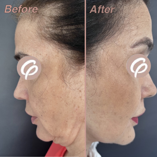before and after-16