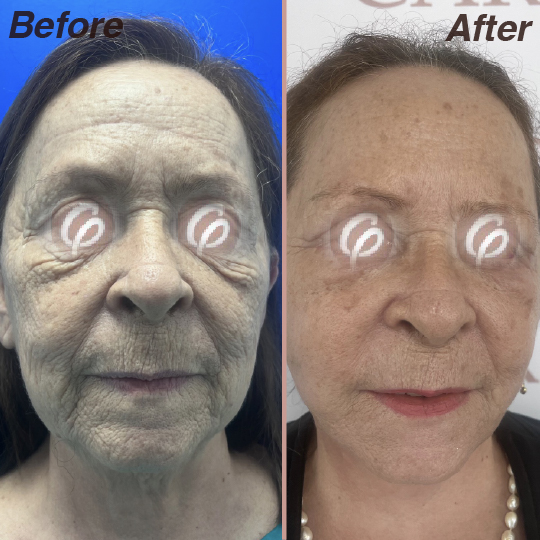 before and after-18