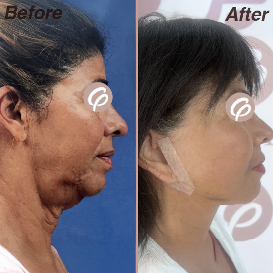 before and after-20