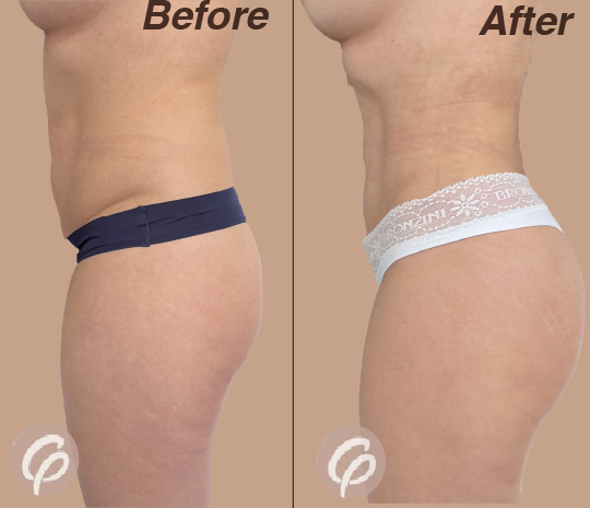 before and after-21