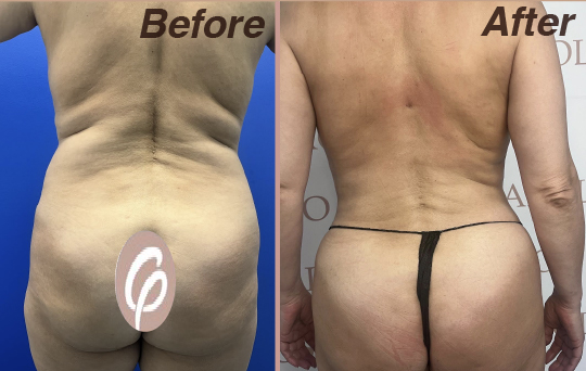 before and after-23