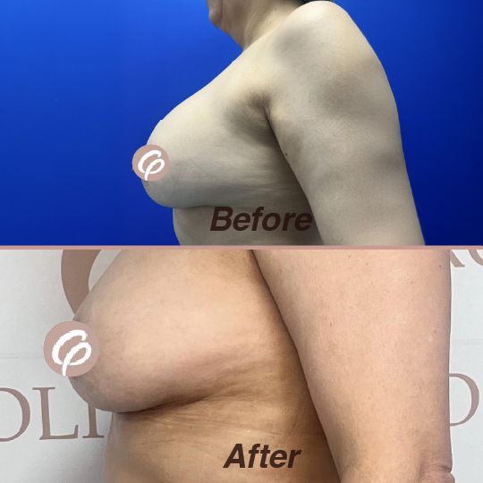 before and after-24