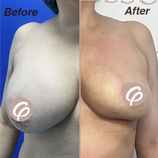 before and after-25