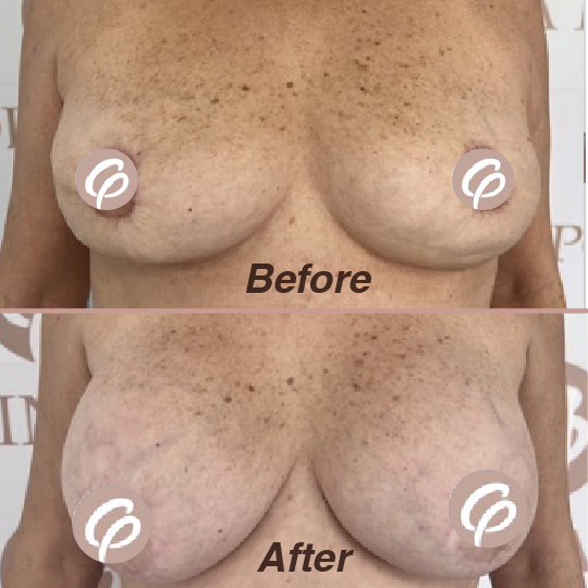before and after-27